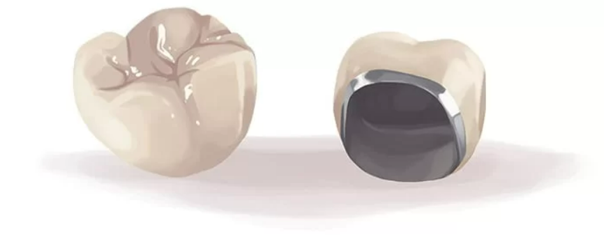روکش متال سرامیک