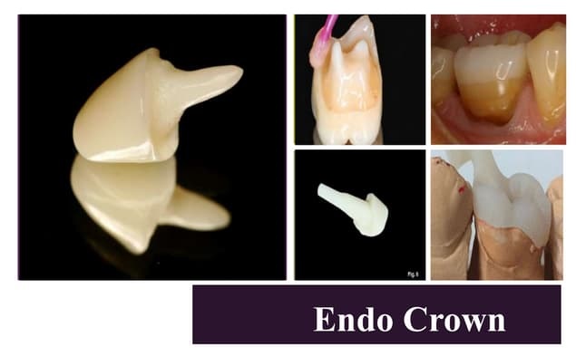 اندو کراون (endocrown)