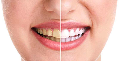 باندینگ دندان چیست و چه فایده ای برای دندان ها دارد؟