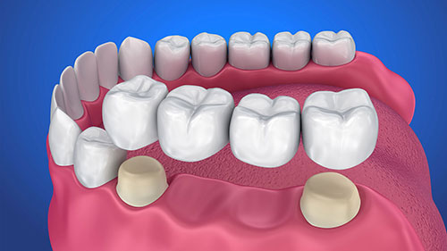 بریج دندان چگونه انجام می شود؟