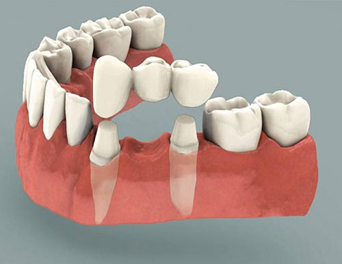 بریج دندان چگونه انجام می شود؟