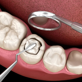 جراحی ریشه دندان چیست و چه کاربردی دارد؟