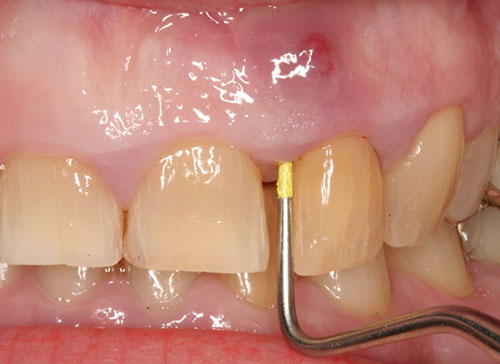 عفونت آبسه دندان 