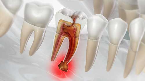 چگونه اقدام به درمان عفونت ریشه دندان نماییم؟