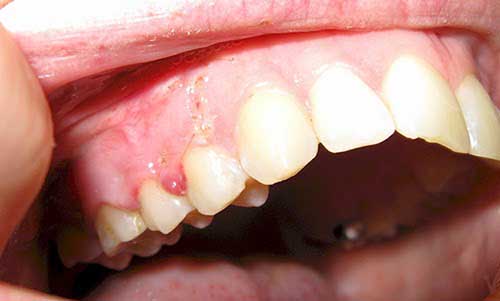 درمان کیست دندان