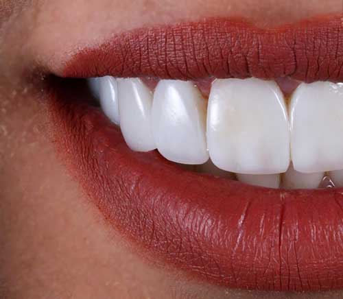 عوارض کامپوزیت دندان چیست؟