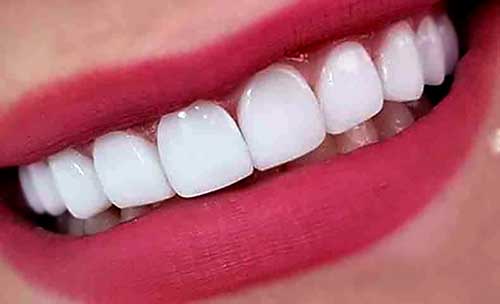 عوارض کامپوزیت دندان چیست؟