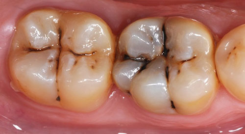 علل پوسیدگی دندان را بدانیم.