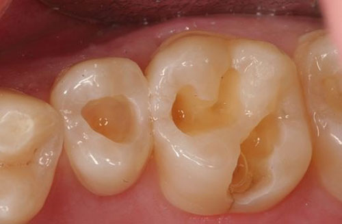 علل پوسیدگی دندان را بدانیم.