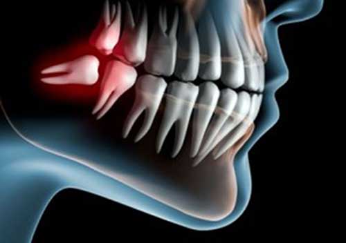 دندان عقل نهفته چیست و چگونه درمان میشود؟