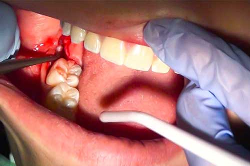 بهبودی پس از کشیدن دندان