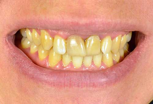 علت تغییر رنگ دندان چیست؟