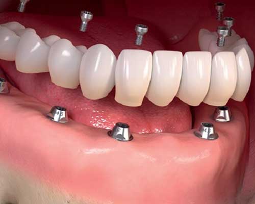 مراقبت های بعد از انجام ایمپلنت دندان