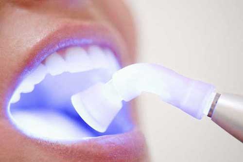 کارکرد لیزر دندانپزشکی 