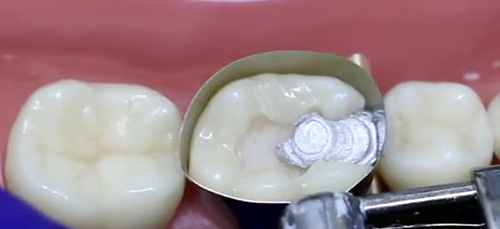 پرکننده های سفید دندان