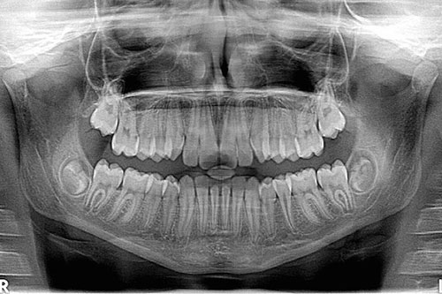 اشعه ایکس دندان