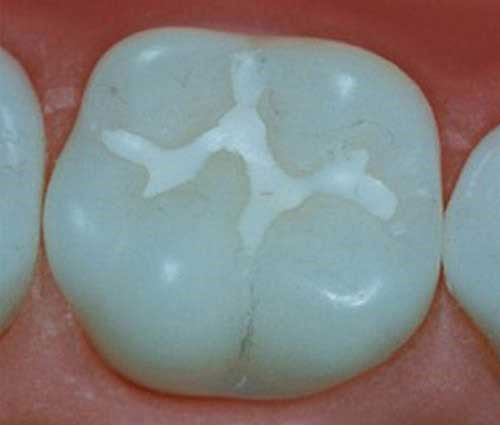 سیلانت دندان