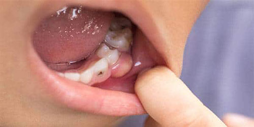 علائم انتشار عفونت دندان در بدن 