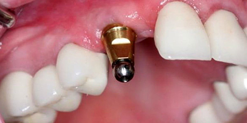 زمان بهبودی ایمپلنت دندان