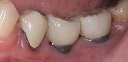 شکست ایمپلنت دندان