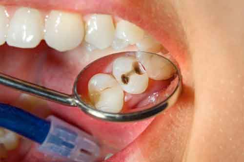 پوسیدگی دندان در کودکان