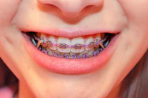 کش ارتودنسی دندان