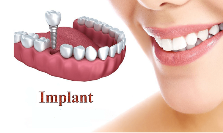 قراردهی ایمپلنت دندان