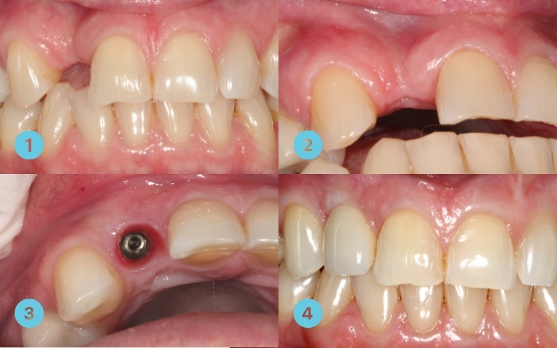 مراحل پیوند استخوان در ایمپلنت دندان