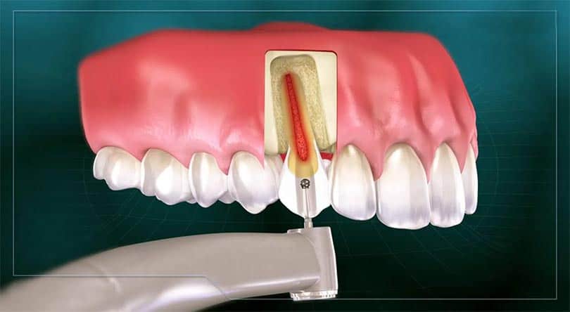 مراقبت های بعد از جراحی ریشه دندان (اپیکواکتومی)