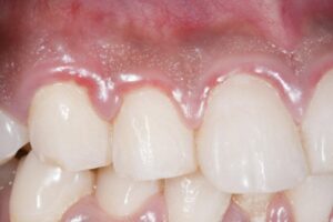 Swollen Gums ورم لثه