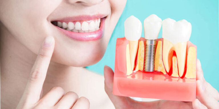 موفقیت کاشت ایمپلنت دندان