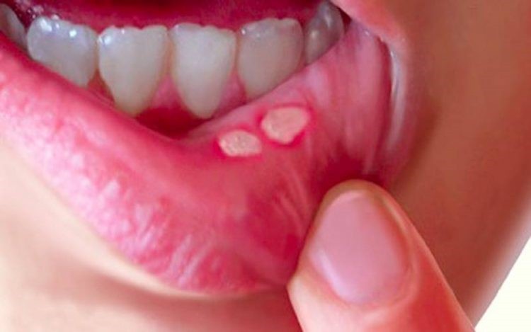 آفت دهان علل علائم و روش‌های درمان