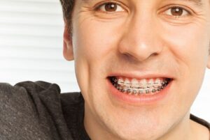 ارتودنسی دندان برای بزرگسالان