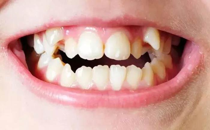تاثیر نامرتبی دندان ها بر سلامت دهان