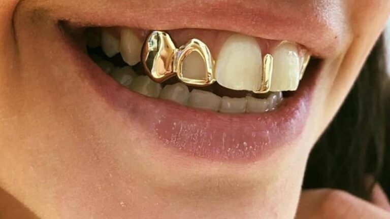 روکش طلا + پر کردن دندان با طلا