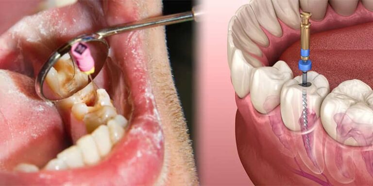 عفونت دندان چیست؟ راه های درمان و پیشگیری از آن