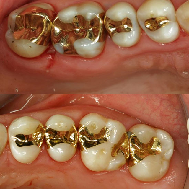 روکش طلا + پر کردن دندان با طلا
