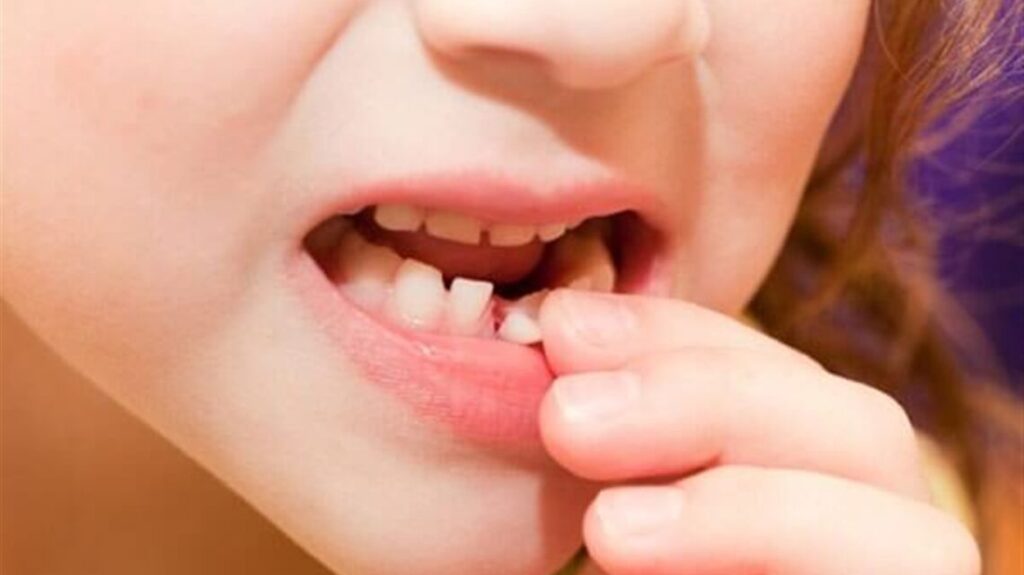 پس از ۶ سالگی، دندان‌های شیری شروع به افتادن می‌کنند